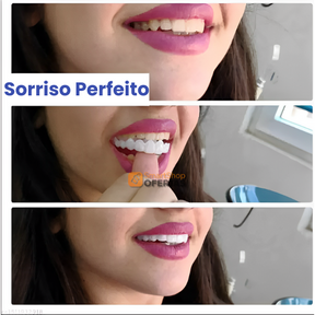 Snapon Smile™ - Facetas Odontológicas Removíveis [Sorriso Perfeito]