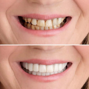 Snapon Smile™ - Facetas Odontológicas Removíveis [Sorriso Perfeito]