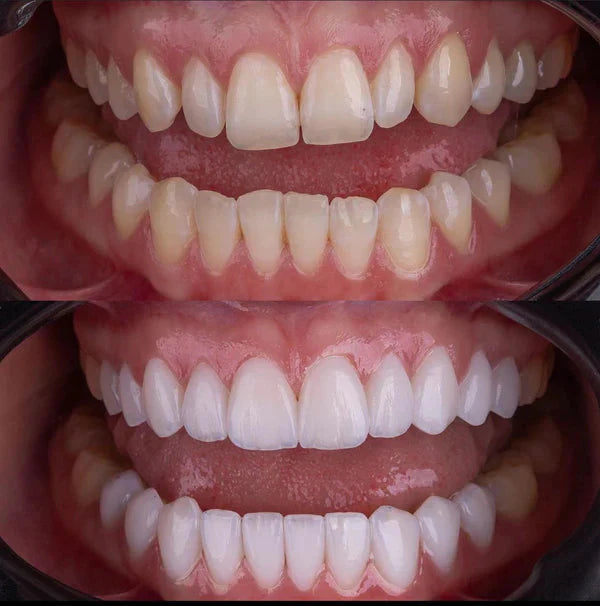 Snapon Smile™ - Facetas Odontológicas Removíveis [Sorriso Perfeito]