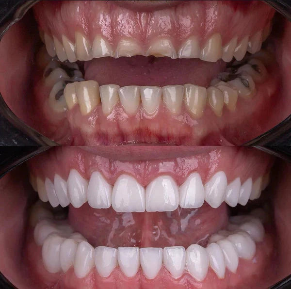 Snapon Smile™ - Facetas Odontológicas Removíveis [Sorriso Perfeito]